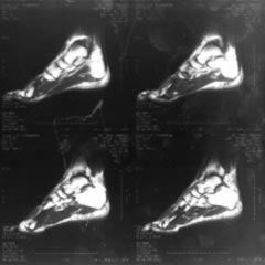 mri image of the right foot